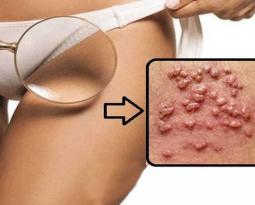 dieu-tri-dut-diem-tinh-trang-noi-mun-mu-vung-kin-chi-sau-1-lieu-trinh